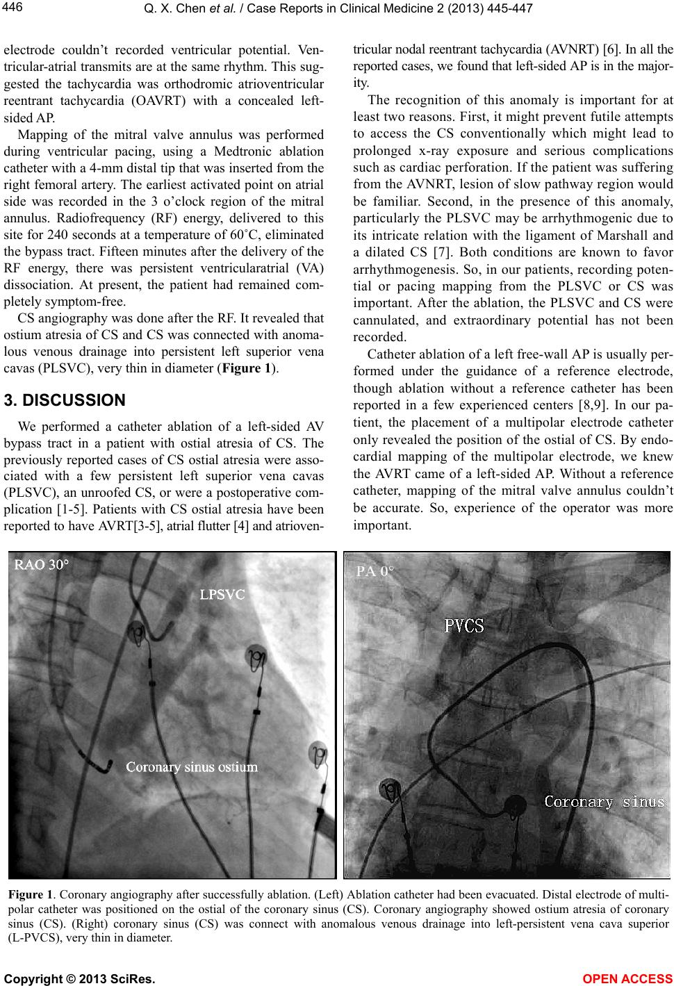 Tricular Successful left-sided accessory pathway ablation without reference ...